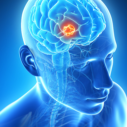Brain Tumor Surgery in Ongole