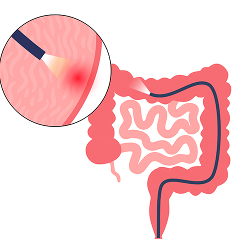 Colonoscopy in Ongole