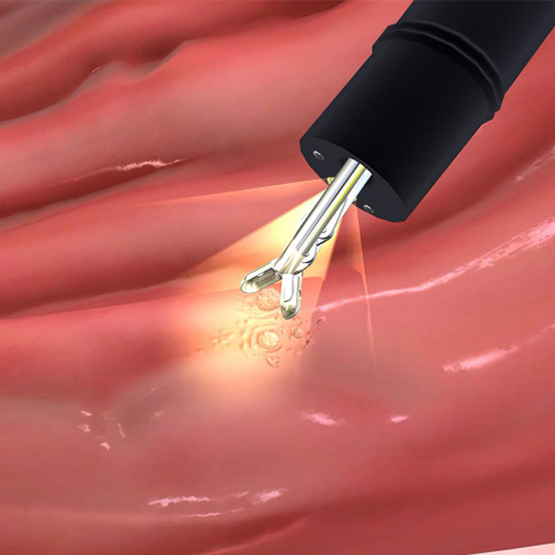 Endoscopic Biopsy in Ongole