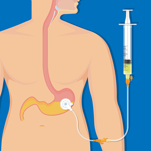 PEG Tube Placement in Ongole